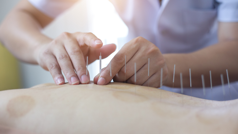 Terapia prin Acupunctură